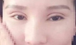 郑州双眼皮爆料案件视频,揭秘整形行业潜规则与维权之路